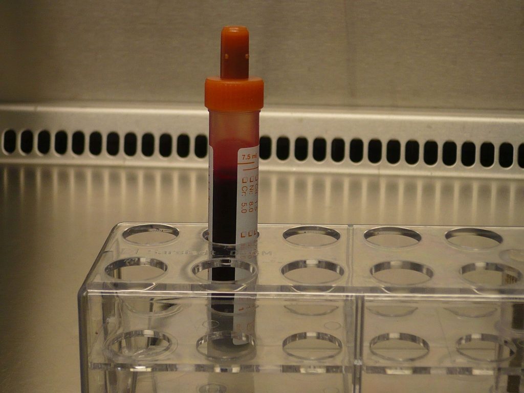 Nuevo test médico abre una vía para detectar cáncer de páncreas